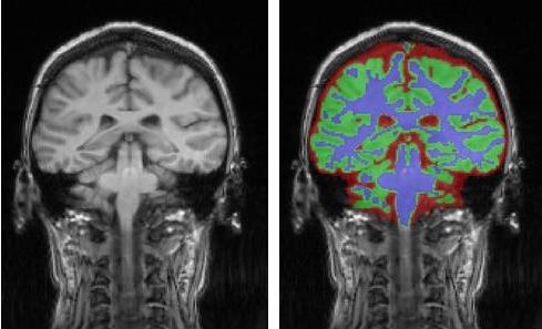 brain segmentation mri robust structure fast